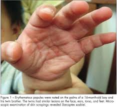 Image result for scabies human children