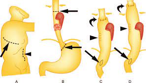 Mckeown esophagectomy is a surgical procedure to remove the esophagus and the upper portion of the stomach. Drawings Illustrate Transthoracic Esophagectomy With A Laparotomy And A Download Scientific Diagram