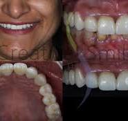 Current status of translucent monolithic zirconia as ...