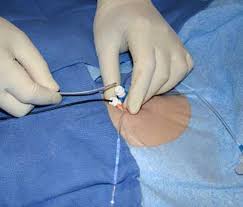 Image result for Radiofrequency Surgery
