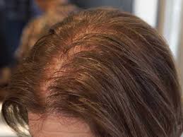 99 ($11.33/ounce) get it as soon as thu, jul 15. The Brand New Idea On How To Hide Scalp With Thin Hair Lewigs