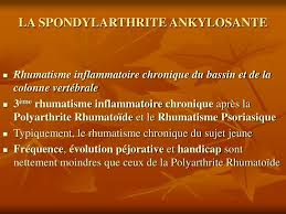 La spondylarthrite ankylosante est la forme la plus typique et la plus sévère, caractérisée par une dans certaines formes sévères, l'évolution peut se faire vers une ankylose rachidienne complète, par. Ppt La Spondylarthrite Ankylosante Powerpoint Presentation Free Download Id 859813
