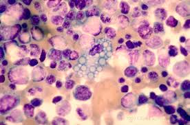 Medical definition of russell bodies. Plasma Cell With Russell Bodies In Small Monoclonal Paraprotein Eccles Health Sciences Library J Willard Marriott Digital Library