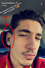 Look into the bellerin's photos, videos, suggestions and interesting statistics from various social media platforms. Photo Hector Bellerin Shows Off Gruesome Injury Ahead Of Man United V Arsenal