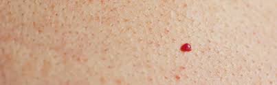 Causes of cherry angioma the specific cause of cherry angiomas remains unknown, but the most likely explanation is random variation in aging cells. What Is A Cherry Angioma Causes Treatment And Removal
