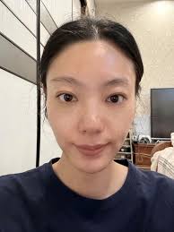 HỘI TUYỂN MẪU TIÊM FILLER & BOTOX