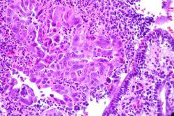 Image result for Acute Cervicitis