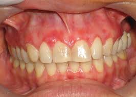 Liquen Plano Dr Ariel Quintana Lopez