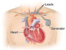 Image result for icd 10 code for presence of biventricular aicd