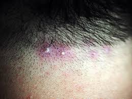 Image result for folliculitis symptoms