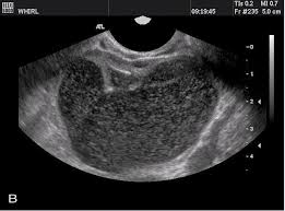 The pelvis also reacts to hormonal restoration and progesterone deficiency antibiotics as it affects over 5. Transvaginal Ultrasonography And Female Infertility Glowm