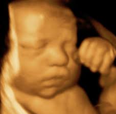 3d ultrasound is a medical ultrasound technique commonly used at our brooklyn gynecology. 3d Ultrasound 34 Weeks 3d 4d Ultrasound