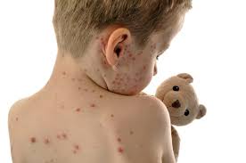 Image result for measles