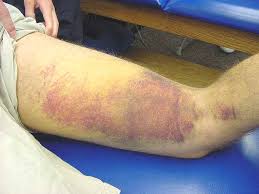 In terms of hamstring injury rate, yeung et al. Hamstring Injuries Knee Sports Orthobullets