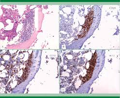 La leucemia mieloide cronica ( lmc ) è una patologia relativamente rara, colpisce circa 2 persone ogni 100.000, prevalentemente adulto/anziano, che si sviluppa a livello del midollo osseo. Medula Osea Con Infiltracion Por Leucemia Mieloide Cronica Infiltrado Download Scientific Diagram