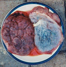 The risk of placenta accreta spectrum in women with in vitro whole blood transfusion reduces overall component transfusion in cases of placenta accreta. Cookbook Placenta Wikibooks Open Books For An Open World