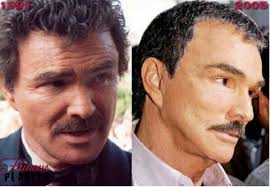 Before And After Plastic Surgery Burt Reynolds Celebrity Plastic Surgery Plastic Surgery Botched Plastic Surgery
