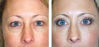 Laser Blepharoplasty Eyelid Surgery Things You Should Know About Hooded Eye Surgery Eyelid Surgery Eye Bag Surgery