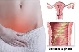 Image result for bacterial vaginosis
