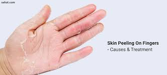 Peeling skin on hands in adults could include symptoms like blisters that break and cause the skin to peel, dry skin that tends to itch, flaky skin, rashes, reaction to the environment like sunburns, and other skin problems. Skin Peeling On Fingers Near Nails Between Fingers Palms Of Hands