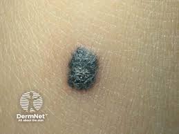 Image result for Spitz Nevus