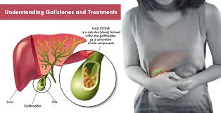 Image result for Gallstone