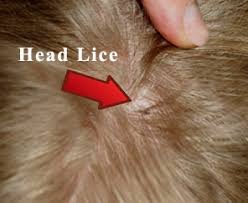 ayurveda home remes for head lice