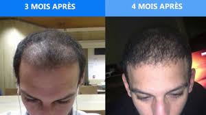 Chez sanantur clinic, nous vous donnons la réponse, nous vous conseillons et résolvons tous les doutes que vous pourriez avoir. Temoignage Et Avis Greffe De Cheveux Turquie Avec Turkisme Greffe De Cheveux Greffe Cheveux