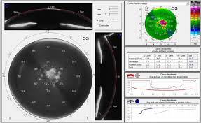Corneal Stromal Abnormalities: Haze, Ectasia, Keratitis And More