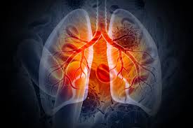 Image result for Lung Cancer