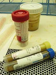 It is also important to inform your doctor if you have recently. Stool Test Wikipedia