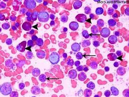 La esperanza de vida de los pacientes con leucemia mieloide crónica se está aproximando a la de la población general, como resultado del exitoso tratamiento con inhibidores de la tirosina cinasa (itk). Leucemia Mieloide Cronica Patologia Silenciosa Analitica Com