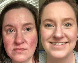 Skin Redness? You Have To Try This | Dermacare
