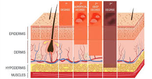 A deep partial thickness burn is more severe. Identifying A Severe Burn Elite Medical Center