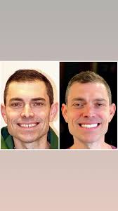 Look at that smile 😊 Curated with our digital smile design process using  in-house 3-D printing technology. Placed new smile all in one day, and  delivered final veneers after two weeks to accommodate ...