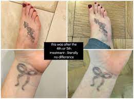 In laser tattoo removal will require several treatments. My Experience With Laser Tattoo Removal In Nyc Before After
