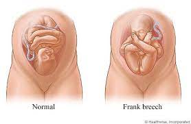 Bumpdate Week 33 Breech Babies Baby In Womb 32 Weeks Pregnant