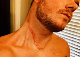 Scar From Carotid Artery Surgery Carotid Artery Arteries Scar