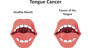 Image result for cancer of tongue