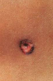 Blunt force and physical trauma: Gunshot Wounds A Forensic Pathology Point Of View American Warrior Society