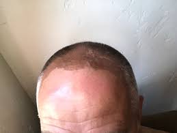 Aug 17, 2020 · rub the skin; I Don T Always Get Sunburnt Cheap Skin Peel Steemkr