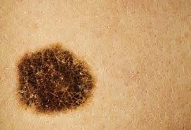 Here's how to identify a melanoma, basal cell carcinoma, squamous cell carcinoma, and more. Skin Problems Skin Conditions Below The Waist