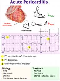 Myocarditis and pericarditis may be difficult or impossible to prevent, but prompt recognition and treatment of these conditions will improve the chances of recovery. Emdocs Net Emergency Medicine Educationem 3am Pericarditis Emdocs Net Emergency Medicine Education