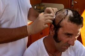 Resultado de imagem para padilla suturado