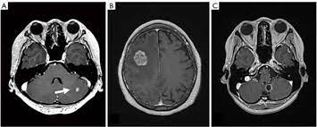 Management Of Breast Cancer Brain Metastases Takahashi Chinese Clinical Oncology