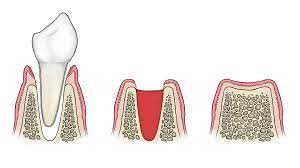 Check spelling or type a new query. 9 Important Facts About Wisdom Teeth And Tooth Removal Webdento