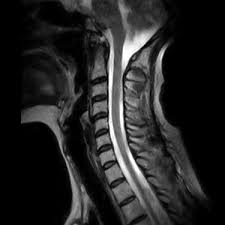 Przy współpracy z awf wrocław, zapraszamy chorych na stwardnienie rozsiane (sm) oraz osoby po udarze mózgu na cykl zabiegów z wykorzystaniem rezonansu stochastycznego (srt). Rezonans Magnetyczny Kregoslupa Szpital Dworska