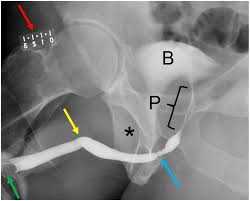 Image result for Retrograde Urethrogram