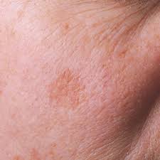 Anti aging sunscreen is a hot topic. Sun Spots 5 Natural Ways To Help Treat Sun Damaged Skin Dr Axe