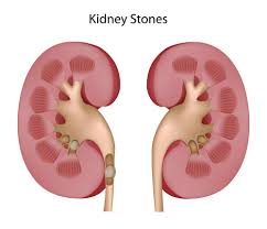 Image result for Calcium Nephrolithiasis
